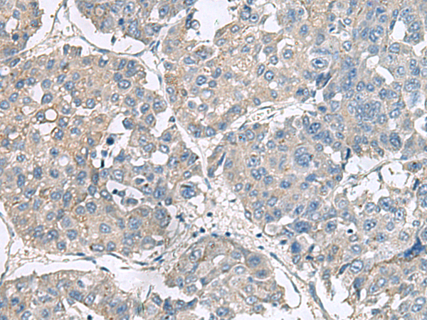 Immunohistochemistry of paraffin-embedded Human liver cancer tissue  using NPHP1 Polyclonal Antibody at dilution of 1:75(×200)