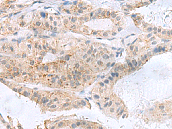 Immunohistochemistry of paraffin-embedded Human thyroid cancer tissue  using PHLDA3 Polyclonal Antibody at dilution of 1:110(×200)