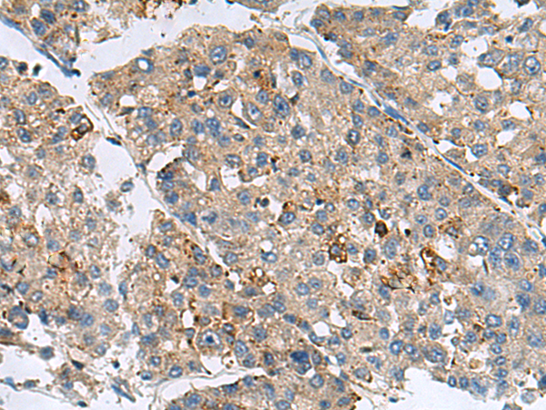 Immunohistochemistry of paraffin-embedded Human liver cancer tissue  using MED31 Polyclonal Antibody at dilution of 1:100(×200)