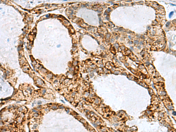 Immunohistochemistry of paraffin-embedded Human thyroid cancer tissue  using MED31 Polyclonal Antibody at dilution of 1:100(×200)
