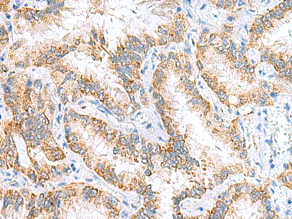 Immunohistochemistry of paraffin-embedded Human lung cancer tissue  using RIDA Polyclonal Antibody at dilution of 1:65(×200)