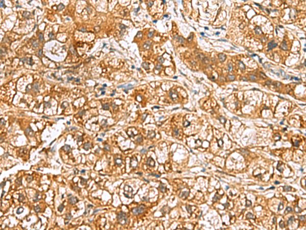 Immunohistochemistry of paraffin-embedded Human liver cancer tissue  using RIDA Polyclonal Antibody at dilution of 1:65(×200)