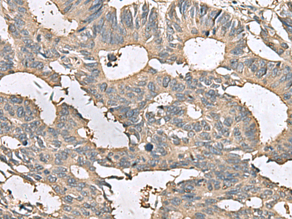 Immunohistochemistry of paraffin-embedded Human colorectal cancer tissue  using MRPL42 Polyclonal Antibody at dilution of 1:65(×200)