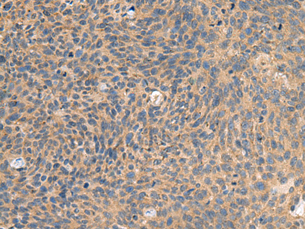 Immunohistochemistry of paraffin-embedded Human cervical cancer tissue  using EIF1AX Polyclonal Antibody at dilution of 1:65(×200)