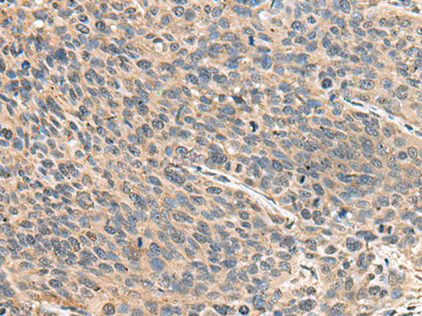 Immunohistochemistry of paraffin-embedded Human cervical cancer tissue  using RPS14 Polyclonal Antibody at dilution of 1:50(×200)