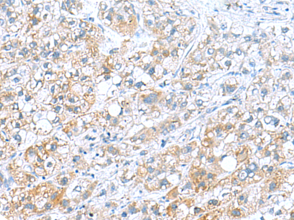 Immunohistochemistry of paraffin-embedded Human liver cancer tissue  using DNAL1 Polyclonal Antibody at dilution of 1:70(×200)