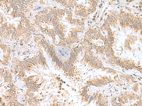 Immunohistochemistry of paraffin-embedded Human lung cancer tissue  using CPLX3 Polyclonal Antibody at dilution of 1:55(×200)