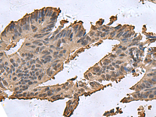 Immunohistochemistry of paraffin-embedded Human colorectal cancer tissue  using DCTPP1 Polyclonal Antibody at dilution of 1:85(×200)