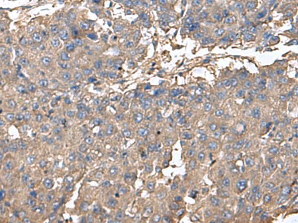 Immunohistochemistry of paraffin-embedded Human liver cancer tissue  using BLOC1S6 Polyclonal Antibody at dilution of 1:95(×200)