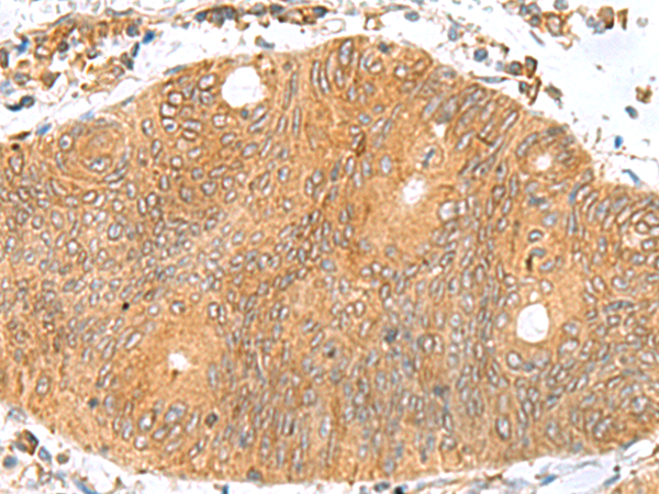 Immunohistochemistry of paraffin-embedded Human colorectal cancer tissue  using TXNDC12 Polyclonal Antibody at dilution of 1:70(×200)