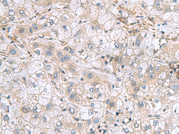 Immunohistochemistry of paraffin-embedded Human liver cancer tissue  using TXNDC12 Polyclonal Antibody at dilution of 1:70(×200)