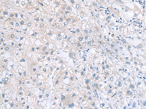 Immunohistochemistry of paraffin-embedded Human liver cancer tissue  using MYDGF Polyclonal Antibody at dilution of 1:70(×200)