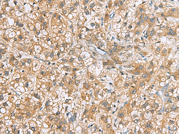 Immunohistochemistry of paraffin-embedded Human liver cancer tissue  using DNPH1 Polyclonal Antibody at dilution of 1:60(×200)