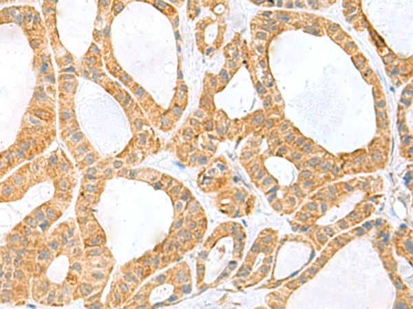 Immunohistochemistry of paraffin-embedded Human thyroid cancer tissue  using PPIH Polyclonal Antibody at dilution of 1:60(×200)