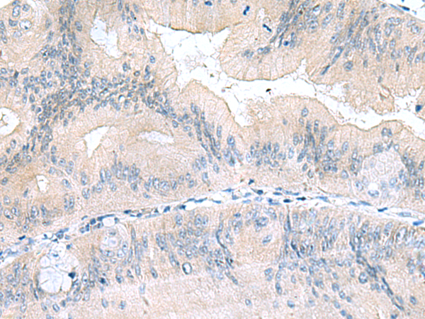 Immunohistochemistry of paraffin-embedded Human colorectal cancer tissue  using UBE2F Polyclonal Antibody at dilution of 1:70(×200)