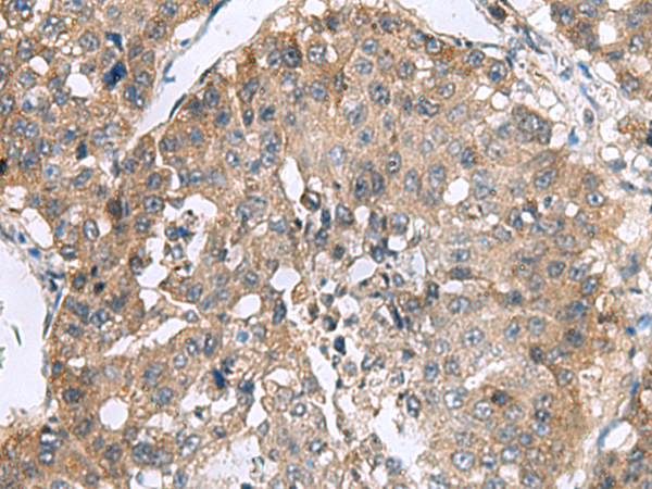 Immunohistochemistry of paraffin-embedded Human liver cancer tissue  using RPL18 Polyclonal Antibody at dilution of 1:70(×200)