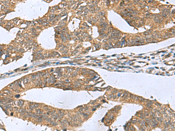 Immunohistochemistry of paraffin-embedded Human colorectal cancer tissue  using RPL18 Polyclonal Antibody at dilution of 1:70(×200)