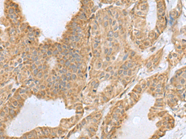 Immunohistochemistry of paraffin-embedded Human thyroid cancer tissue  using CSRP2 Polyclonal Antibody at dilution of 1:60(×200)