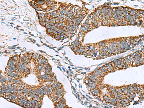 Immunohistochemistry of paraffin-embedded Human colorectal cancer tissue  using PRELID3B Polyclonal Antibody at dilution of 1:90(×200)