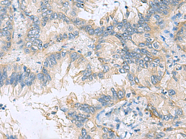 Immunohistochemistry of paraffin-embedded Human lung cancer tissue  using TAGLN3 Polyclonal Antibody at dilution of 1:70(×200)