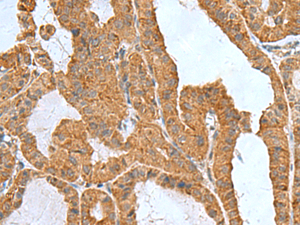 Immunohistochemistry of paraffin-embedded Human thyroid cancer tissue  using ITGB1BP1 Polyclonal Antibody at dilution of 1:50(×200)