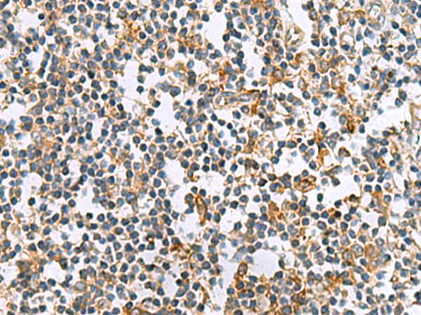 Immunohistochemistry of paraffin-embedded Human tonsil tissue  using GUCA1A Polyclonal Antibody at dilution of 1:105(×200)