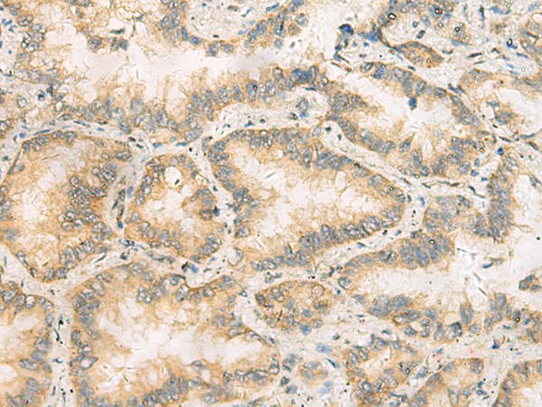 Immunohistochemistry of paraffin-embedded Human lung cancer tissue  using RAB13 Polyclonal Antibody at dilution of 1:50(×200)