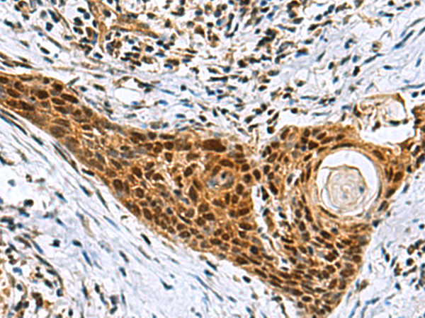 Immunohistochemistry of paraffin-embedded Human esophagus cancer tissue  using NABP1 Polyclonal Antibody at dilution of 1:80(×200)