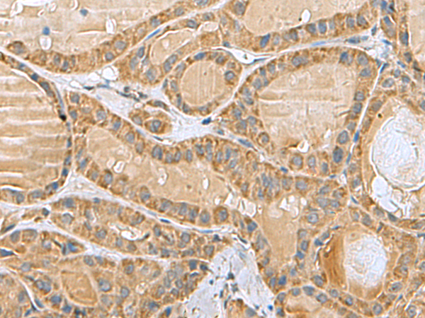 Immunohistochemistry of paraffin-embedded Human thyroid cancer tissue  using MRPL40 Polyclonal Antibody at dilution of 1:80(×200)