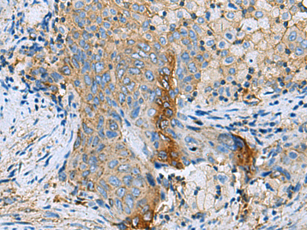 Immunohistochemistry of paraffin-embedded Human cervical cancer tissue  using CLTB Polyclonal Antibody at dilution of 1:70(×200)
