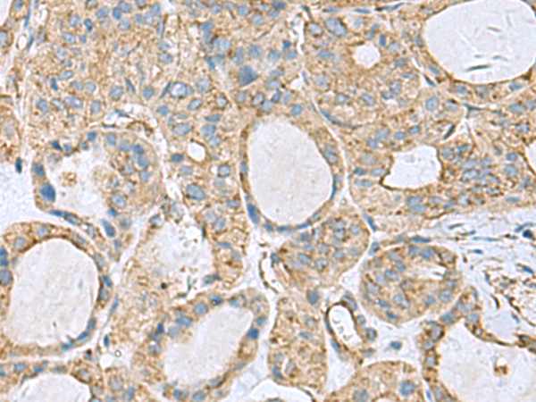Immunohistochemistry of paraffin-embedded Human thyroid cancer tissue  using CLTB Polyclonal Antibody at dilution of 1:70(×200)