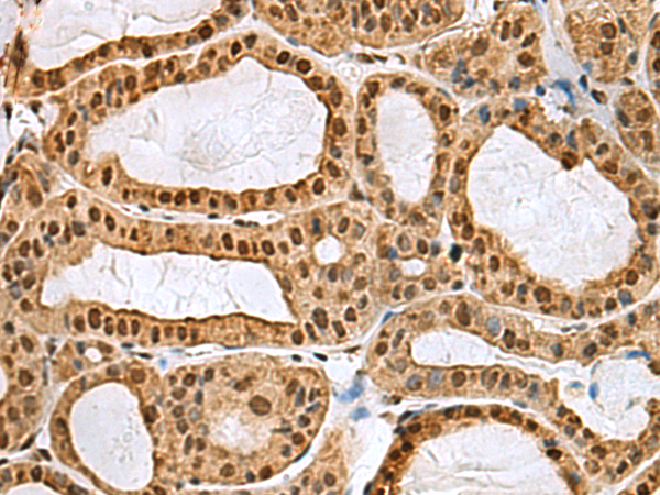 Immunohistochemistry of paraffin-embedded Human thyroid cancer tissue  using MYEF2 Polyclonal Antibody at dilution of 1:55(×200)