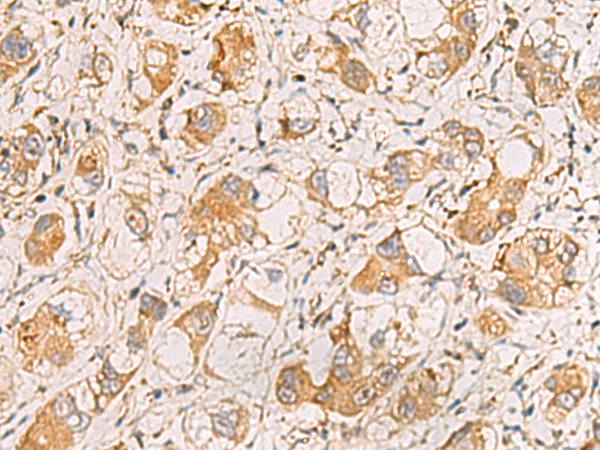 Immunohistochemistry of paraffin-embedded Human liver cancer tissue  using RAB38 Polyclonal Antibody at dilution of 1:60(×200)