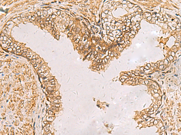 Immunohistochemistry of paraffin-embedded Human prost ate cancer tissue  using RAB38 Polyclonal Antibody at dilution of 1:60(×200)