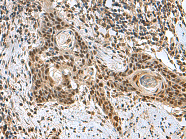 Immunohistochemistry of paraffin-embedded Human esophagus cancer tissue  using PRPF40A Polyclonal Antibody at dilution of 1:60(×200)