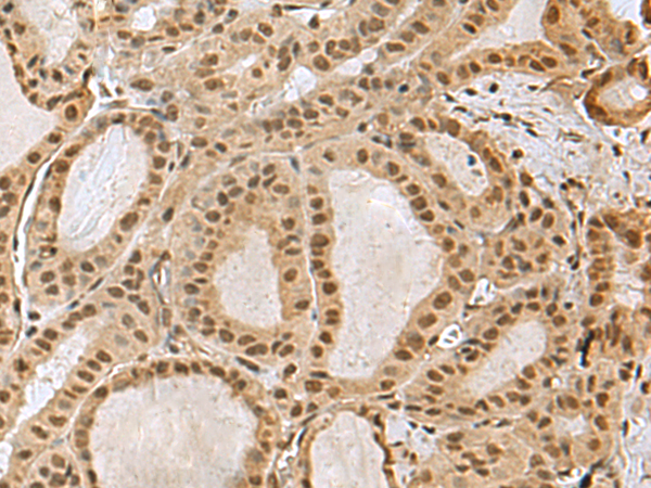 Immunohistochemistry of paraffin-embedded Human thyroid cancer tissue  using PRPF40A Polyclonal Antibody at dilution of 1:60(×200)