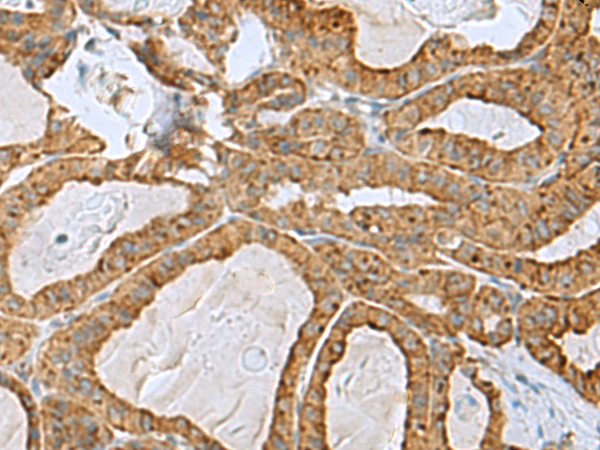 Immunohistochemistry of paraffin-embedded Human thyroid cancer tissue  using RPL10A Polyclonal Antibody at dilution of 1:50(×200)