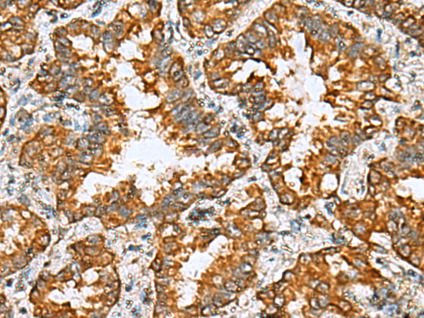 Immunohistochemistry of paraffin-embedded Human lung cancer tissue  using TMED10 Polyclonal Antibody at dilution of 1:65(×200)