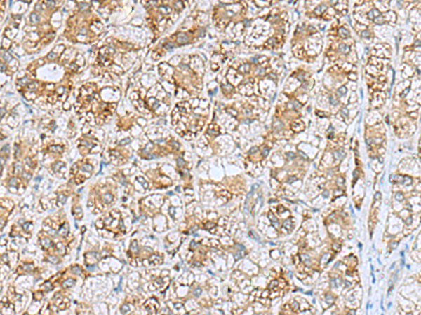 Immunohistochemistry of paraffin-embedded Human liver cancer tissue  using NQO2 Polyclonal Antibody at dilution of 1:70(×200)