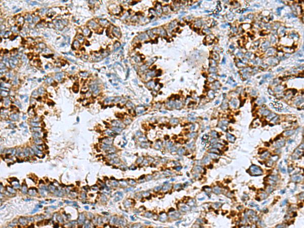 Immunohistochemistry of paraffin-embedded Human lung cancer tissue  using FAAP100 Polyclonal Antibody at dilution of 1:85(×200)