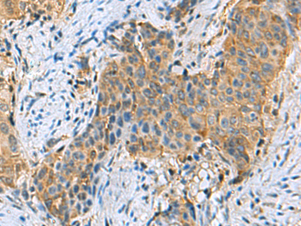 Immunohistochemistry of paraffin-embedded Human cervical cancer tissue  using PSMA6 Polyclonal Antibody at dilution of 1:90(×200)