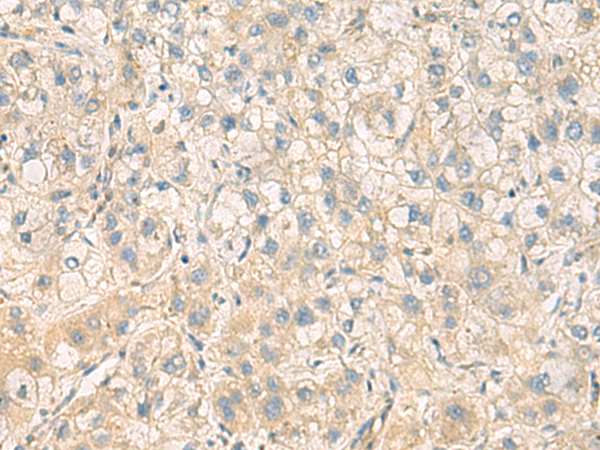 Immunohistochemistry of paraffin-embedded Human liver cancer tissue  using PPM1M Polyclonal Antibody at dilution of 1:100(×200)