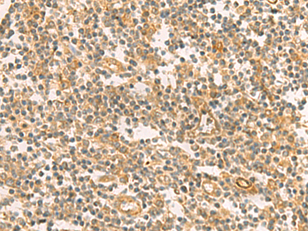 Immunohistochemistry of paraffin-embedded Human tonsil tissue  using PPM1M Polyclonal Antibody at dilution of 1:100(×200)