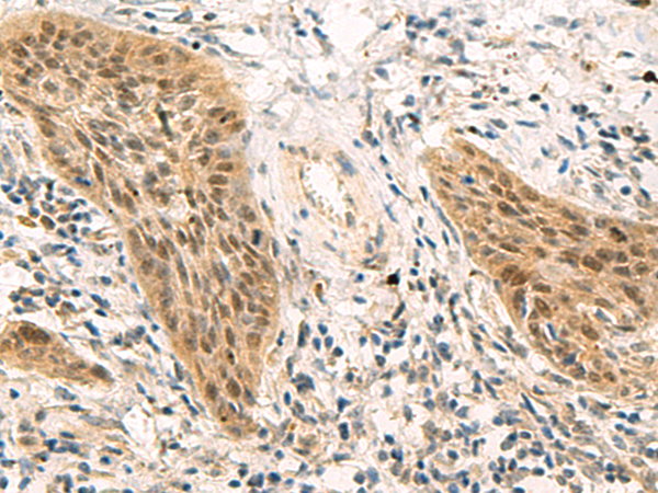 Immunohistochemistry of paraffin-embedded Human esophagus cancer tissue  using PSME1 Polyclonal Antibody at dilution of 1:50(×200)