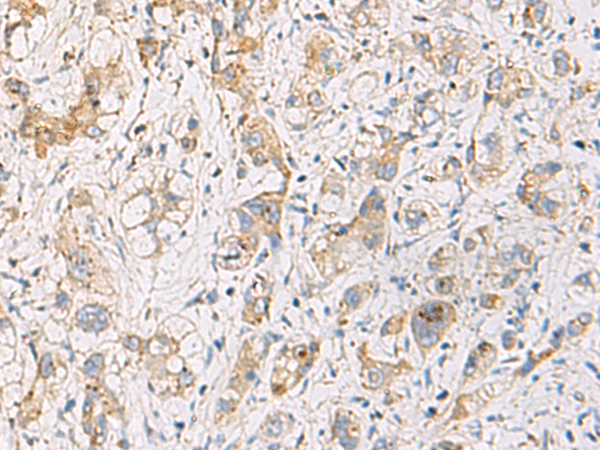 Immunohistochemistry of paraffin-embedded Human liver cancer tissue  using FYCO1 Polyclonal Antibody at dilution of 1:110(×200)