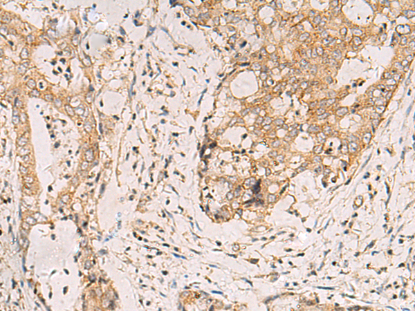 Immunohistochemistry of paraffin-embedded Human cervical cancer tissue  using FYCO1 Polyclonal Antibody at dilution of 1:110(×200)