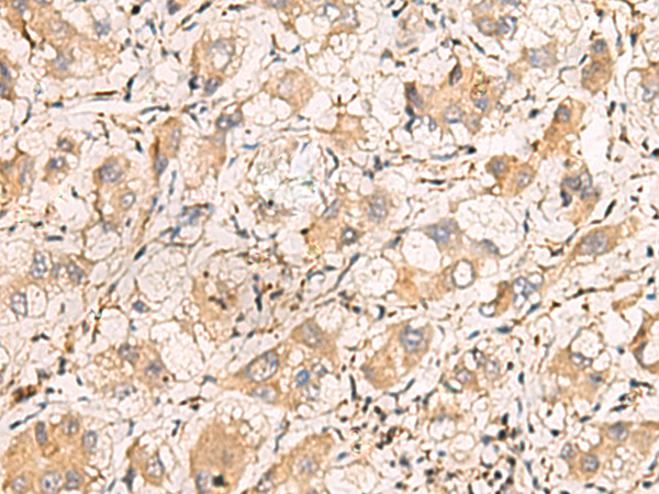 Immunohistochemistry of paraffin-embedded Human liver cancer tissue  using TNNT1 Polyclonal Antibody at dilution of 1:75(×200)