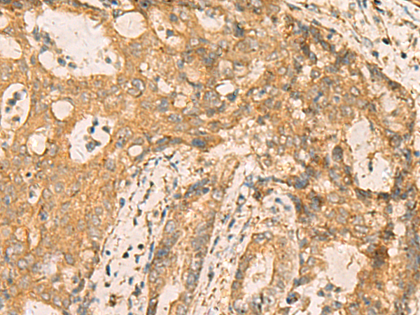 Immunohistochemistry of paraffin-embedded Human cervical cancer tissue  using CNST Polyclonal Antibody at dilution of 1:70(×200)