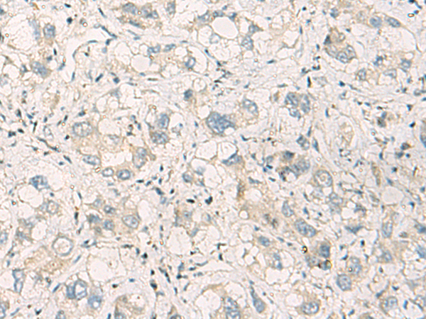 Immunohistochemistry of paraffin-embedded Human liver cancer tissue  using SPSB2 Polyclonal Antibody at dilution of 1:70(×200)