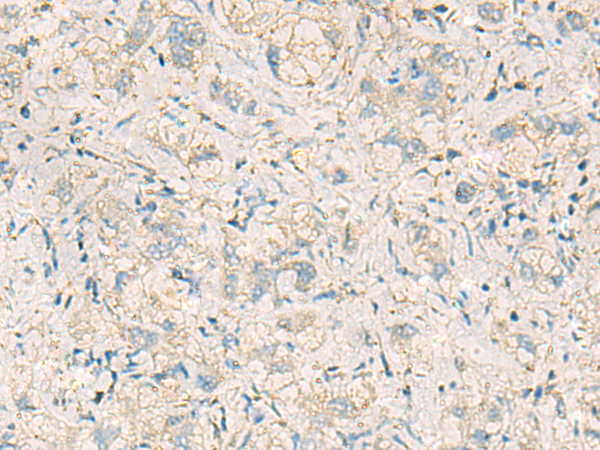 Immunohistochemistry of paraffin-embedded Human liver cancer tissue  using WDR37 Polyclonal Antibody at dilution of 1:50(×200)